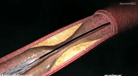 Chirurgie interventionnelle cardiovasculaire