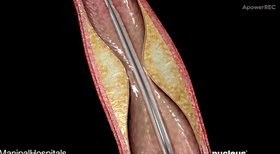 Chirurgie interventionnelle cardiovasculaire