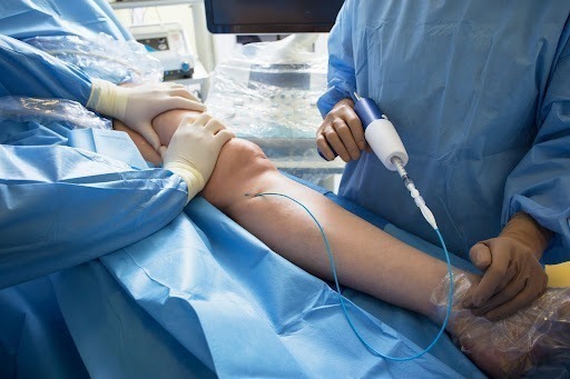 Décapage des varices