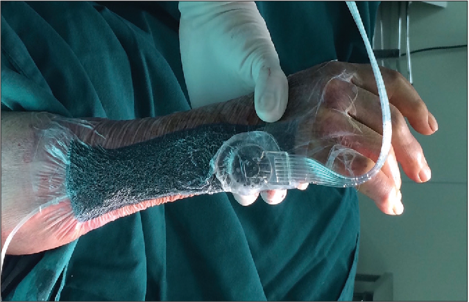 VSD
