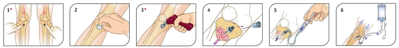 Dispositif de perfusion intra-osseuse (IO)