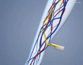 Chirurgie interventionnelle cardiovasculaire