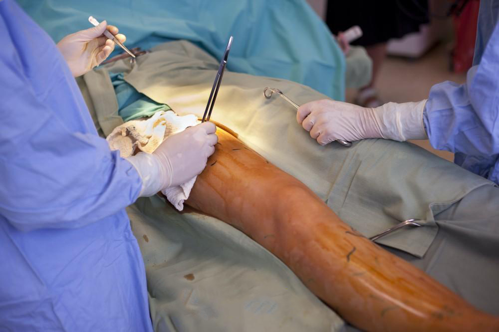 Décapage des varices