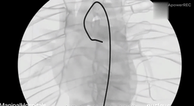 Chirurgie interventionnelle cardiovasculaire