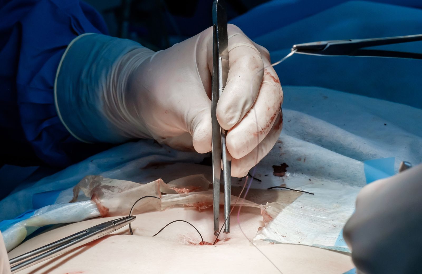 suture r&eacute;sorbable ou non r&eacute;sorbable2.jpg