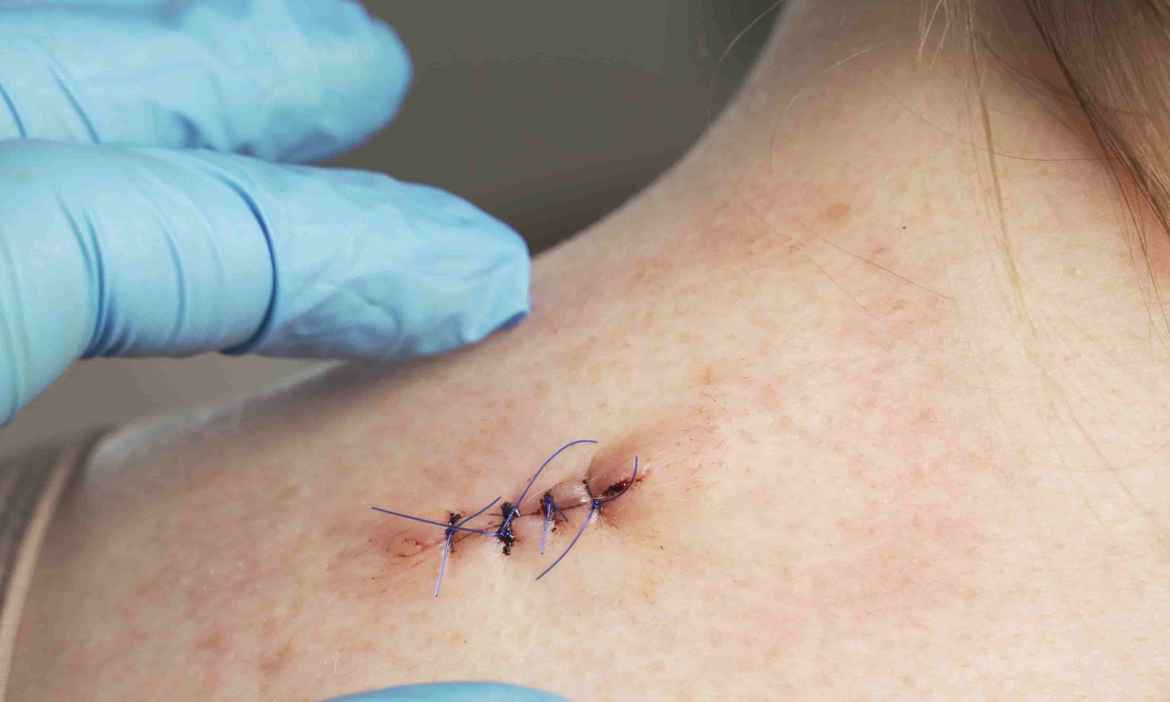 r&eacute;action de suture3.jpg