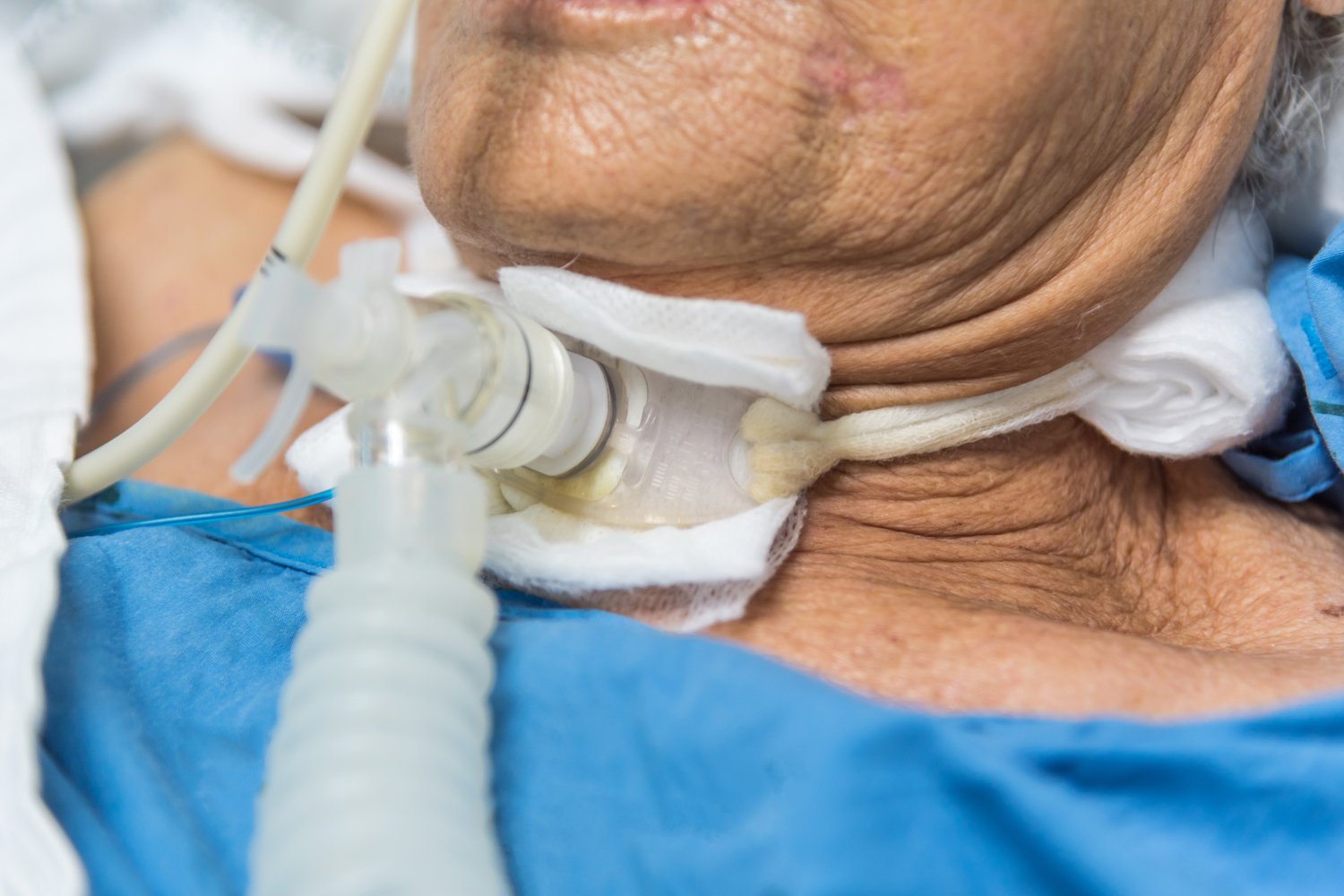 bigstock-Patient-Do-Tracheostomy-And-Ve-247534039