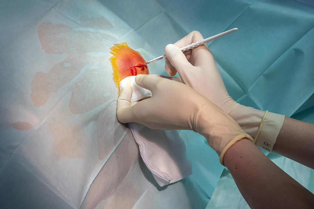 infection du site op&eacute;ratoire3.jpg