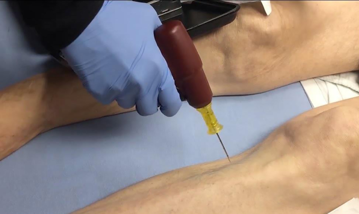 Complications d'acc&egrave;s intra-osseux2