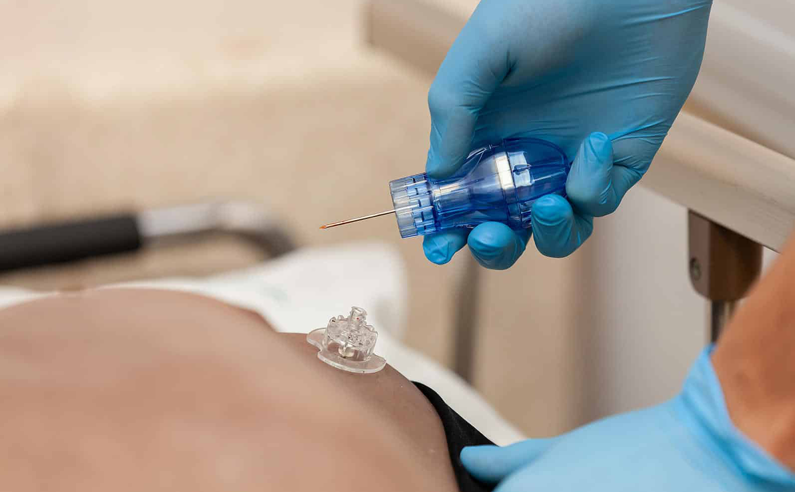 Complications d'acc&egrave;s intra-osseux1