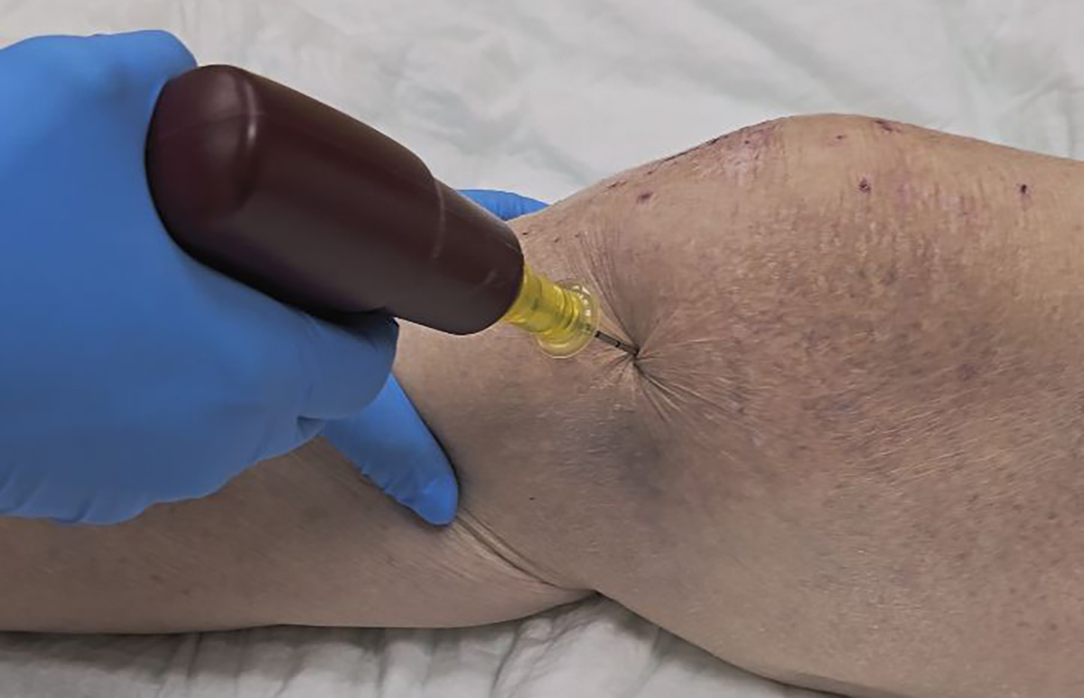 perfusion intra-osseuse2.jpg