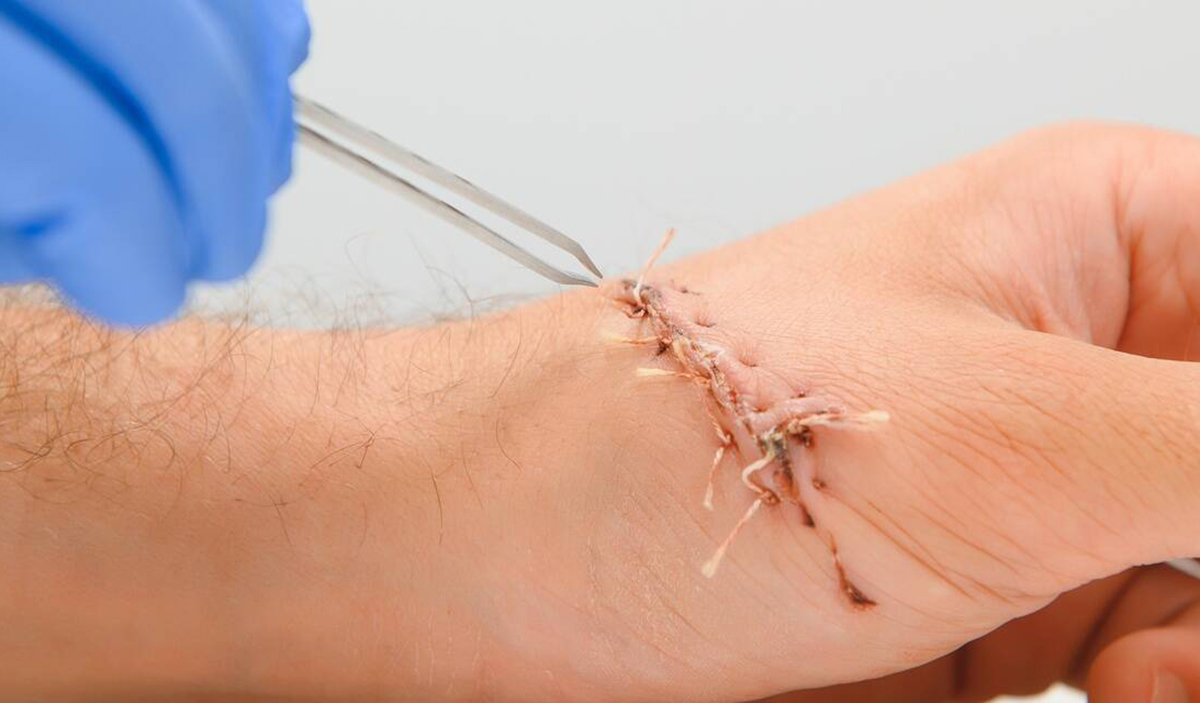 r&eacute;action de suture2.jpg