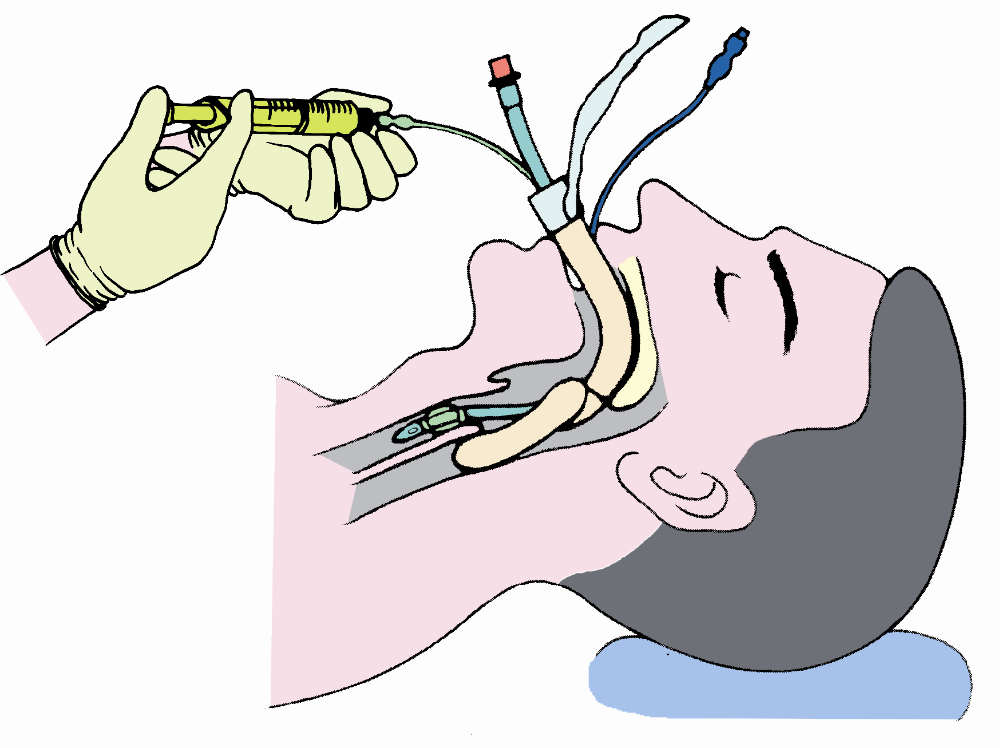 Kit de trachéotomie stérile jetable pour opération de trachéotomie clinique