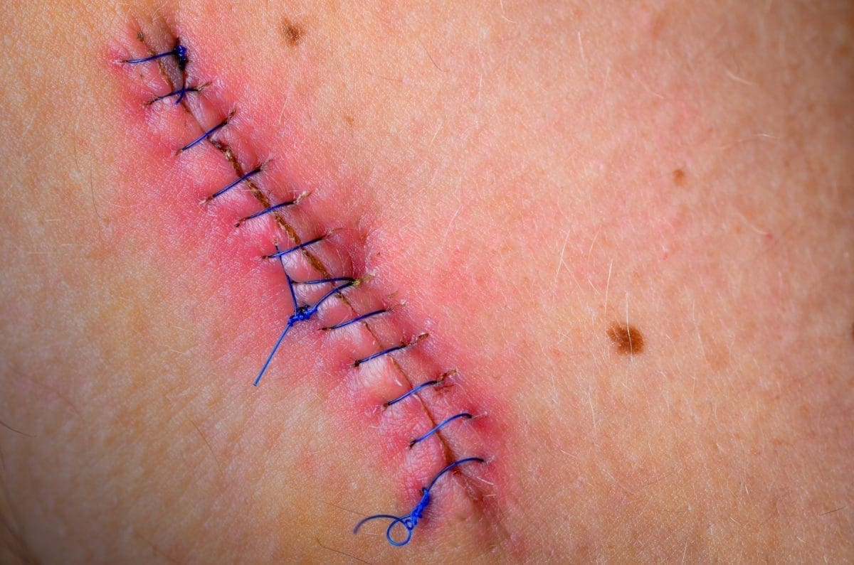 infection du site op&eacute;ratoire2.jpg