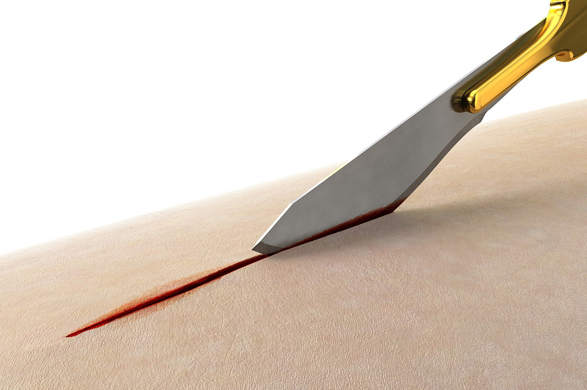 scalpel chirurgical3.jpg