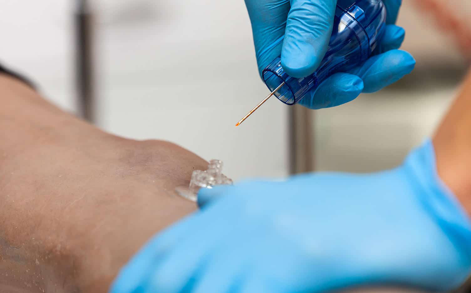 perfusion intra-osseuse3.jpg